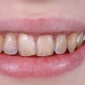 Tooth Enamel Erosion: Causes, Symptoms, and Treatment