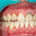 Gum Disease and Gingivitis: Understanding Common Dental Issues