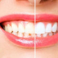 Baking Soda and Hydrogen Peroxide: Teeth Whitening Benefits and How to Use