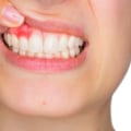 How can we prevent Teeth Problems