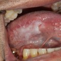 Oral Cancer Screening: A Comprehensive Overview