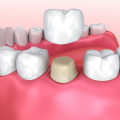 Fillings and Crowns: Understanding Your Dental Treatment Options