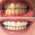 Natural Whitening Remedies for Teeth