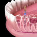 Root Canals for Severe Tooth Decay: What You Need to Know