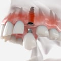 How Painful Is Denture Implants