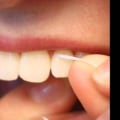 Flossing Techniques: A Comprehensive Overview