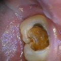 Diagnosing Tooth Decay: An Overview