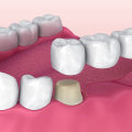 Understanding Dental Implants and Bridges