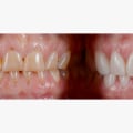 What is Veneers in Dentistry