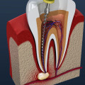 Root Canals and Extractions: A Comprehensive Overview