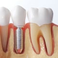 Everything You Need to Know About Dental Implants and Bridges
