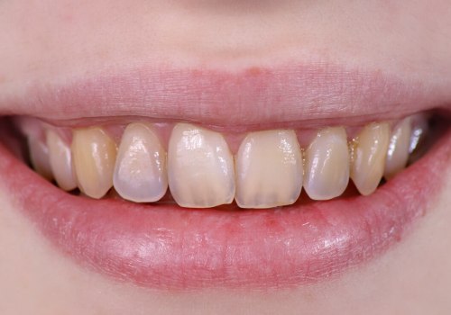 Tooth Enamel Erosion: Causes, Symptoms, and Treatment