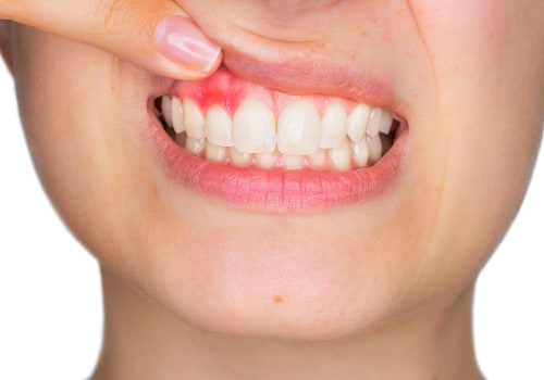 How can we prevent Teeth Problems