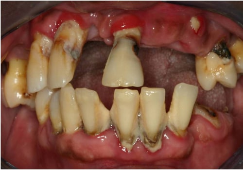 The Effects of Smoking or Tobacco Use on Gum Disease