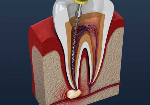 Root Canals and Extractions: An Overview