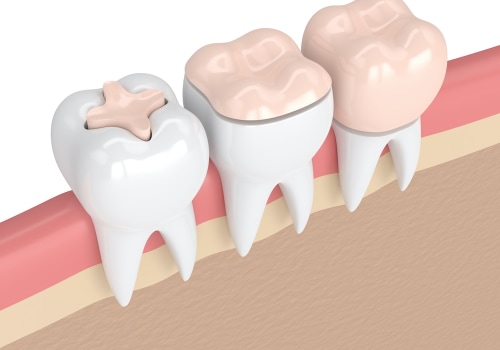 Fillings and Crowns: What You Need to Know