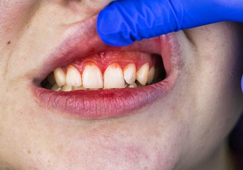 Gingivitis from Hormonal Changes: Causes, Symptoms, and Treatments