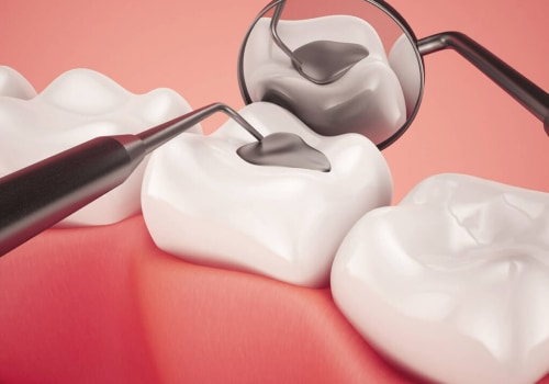 Preventing Tooth Decay: Fluoride and Sealants