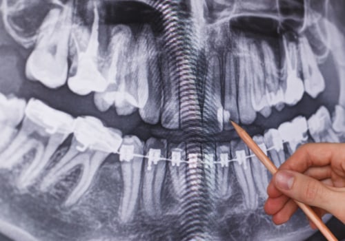 X-rays for Tooth Decay Detection