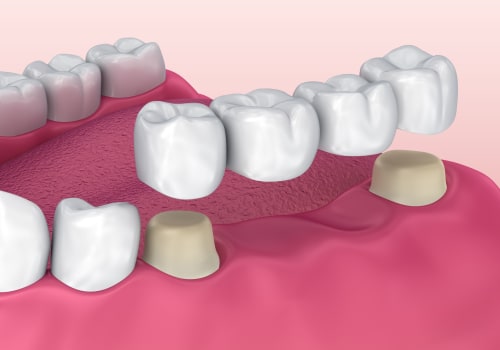 Understanding Dental Implants and Bridges