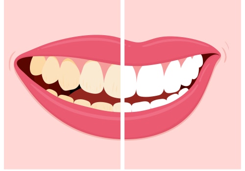 Preventing teeth discoloration: How to Avoid Staining Foods and Drinks